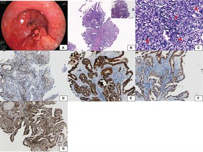 Case report: Gastric carcinoma with SMARCA4 deficient: two cases report and literature review